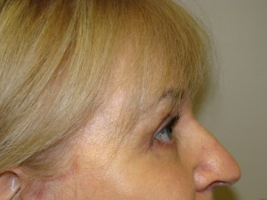 Browlift Before and After 16 | Sanjay Grover MD FACS