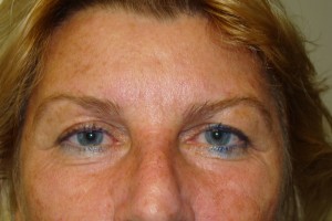 Browlift Before and After 02 | Sanjay Grover MD FACS