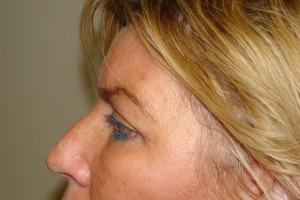 Browlift Before and After 17 | Grover Aesthetics