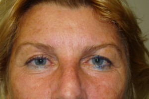 Browlift Before and After | Grover Aesthetics