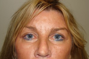 Browlift Before and After | Grover Aesthetics