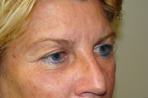 Browlift Before and After 18 | Grover Aesthetics