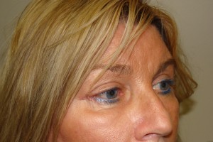Browlift Before and After 18 | Grover Aesthetics