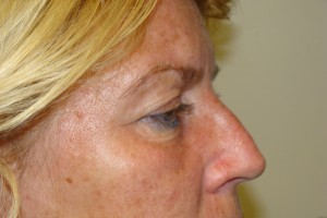 Browlift Before and After 18 | Grover Aesthetics