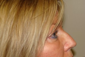 Browlift Before and After 18 | Grover Aesthetics