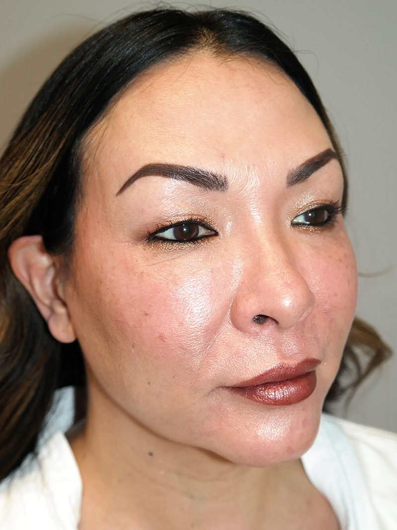 Buccal Fat Reduction Before and After | Grover Aesthetics
