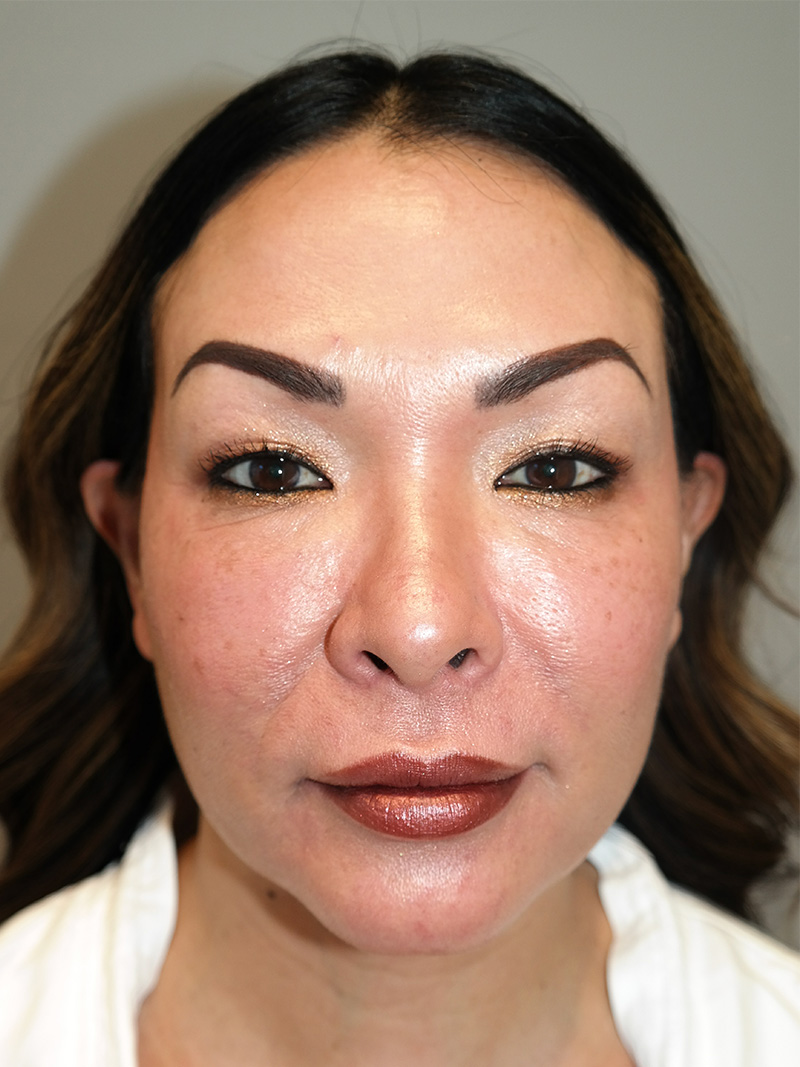 Buccal Fat Reduction Before and After 01 | Grover Aesthetics