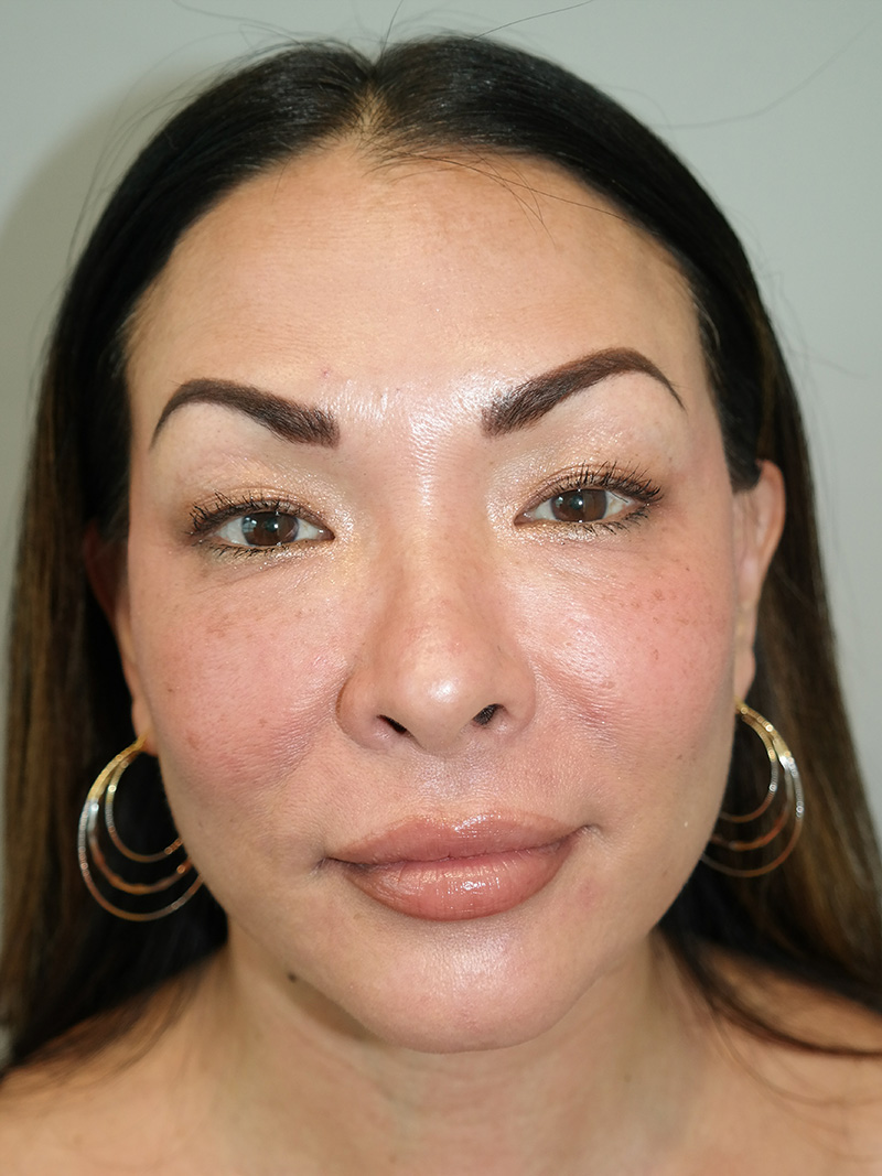 Buccal Fat Reduction Before and After 01 | Grover Aesthetics