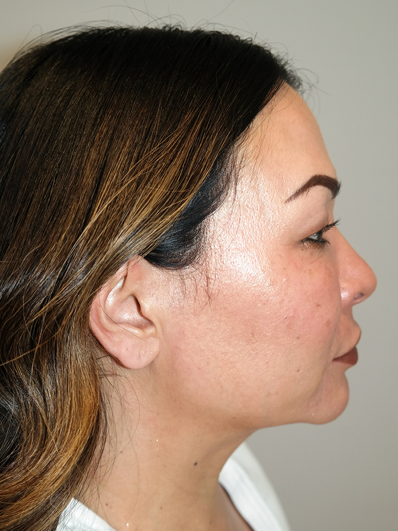 Buccal Fat Reduction Before and After 01 | Grover Aesthetics