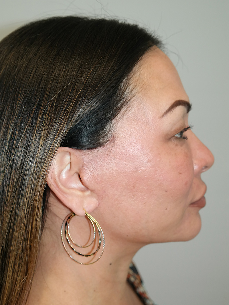 Buccal Fat Reduction Before and After 01 | Grover Aesthetics