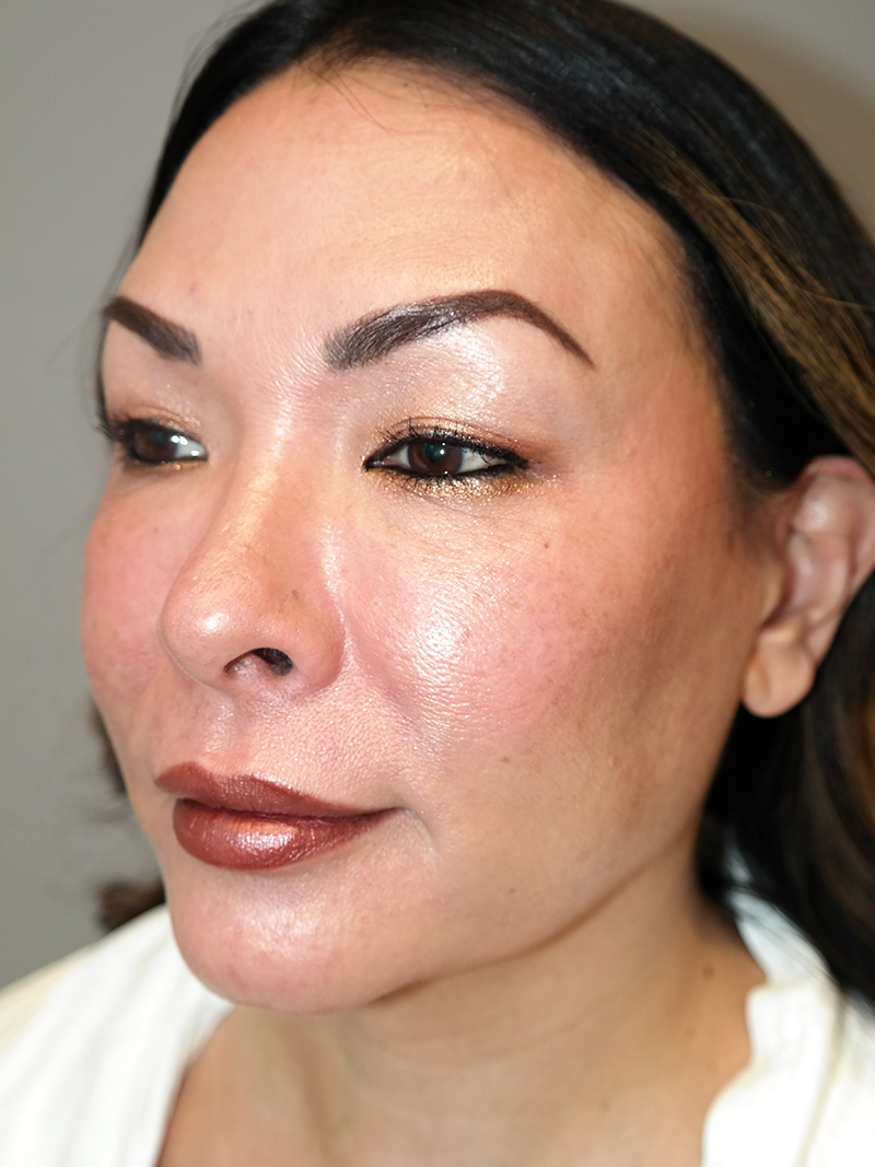 Buccal Fat Reduction Before and After 01 | Grover Aesthetics
