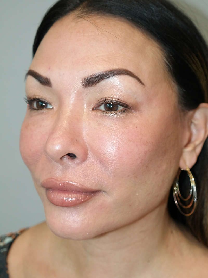 Buccal Fat Reduction Before and After 01 | Grover Aesthetics