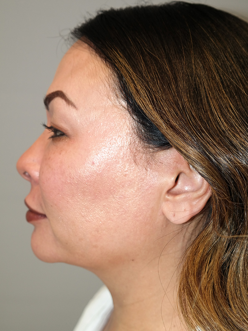 Buccal Fat Reduction Before and After 01 | Grover Aesthetics