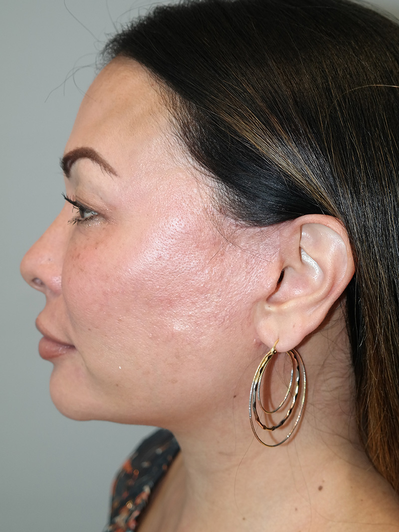 Buccal Fat Reduction Before and After 01 | Grover Aesthetics