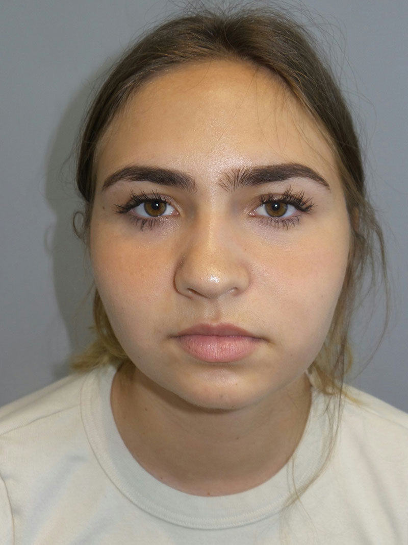 Buccal Fat Reduction Before and After | Grover Aesthetics