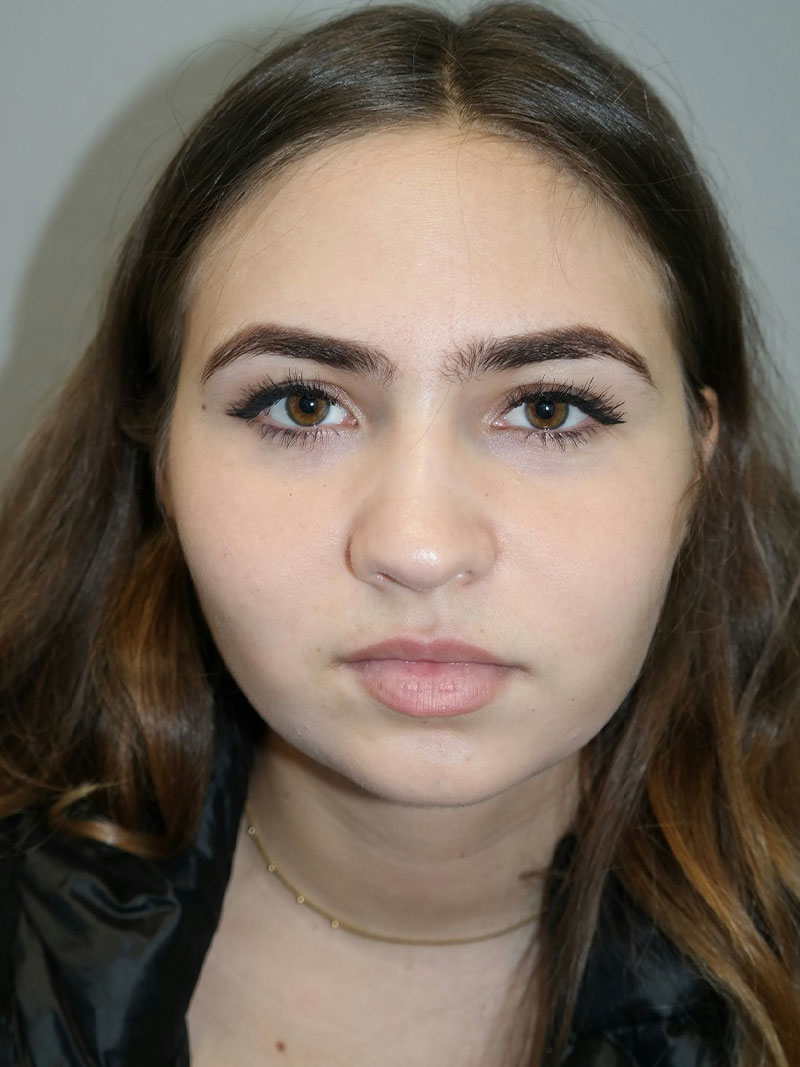 Buccal Fat Reduction Before and After | Grover Aesthetics