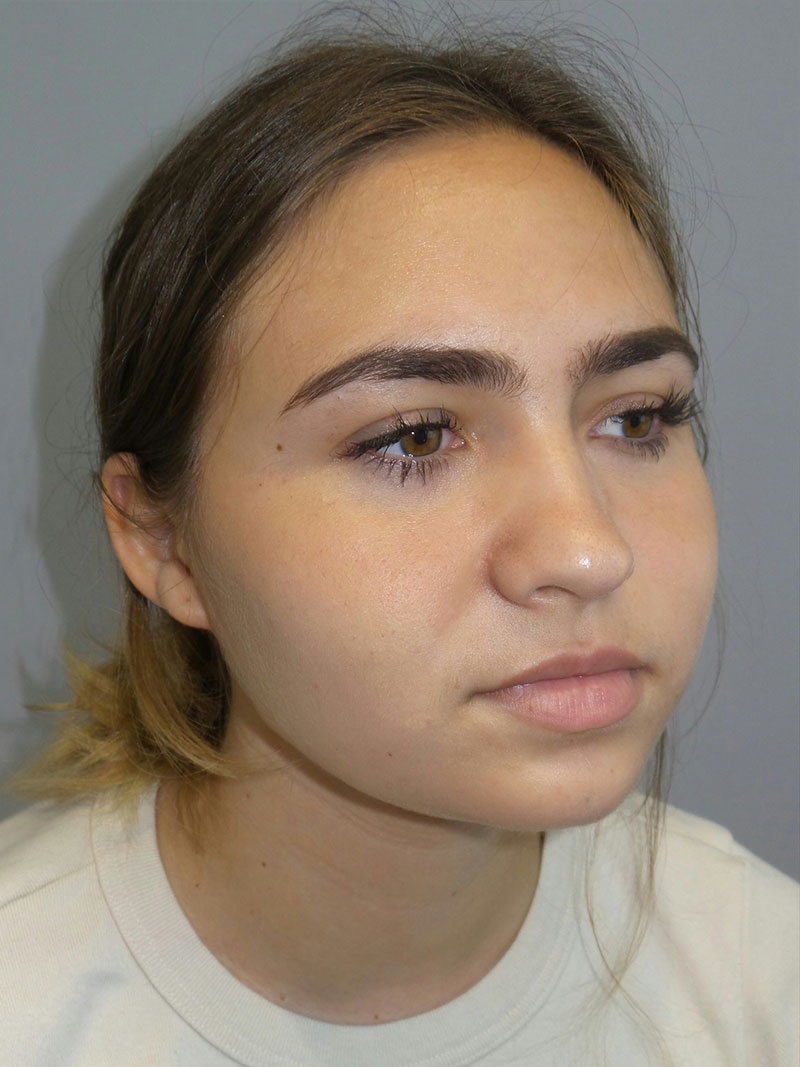 Buccal Fat Reduction Before and After 02 | Grover Aesthetics