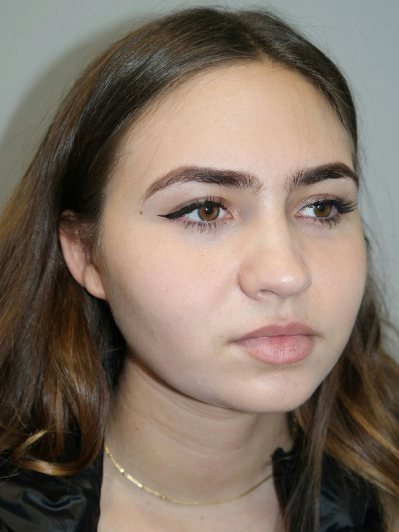 Buccal Fat Reduction Before and After 02 | Grover Aesthetics