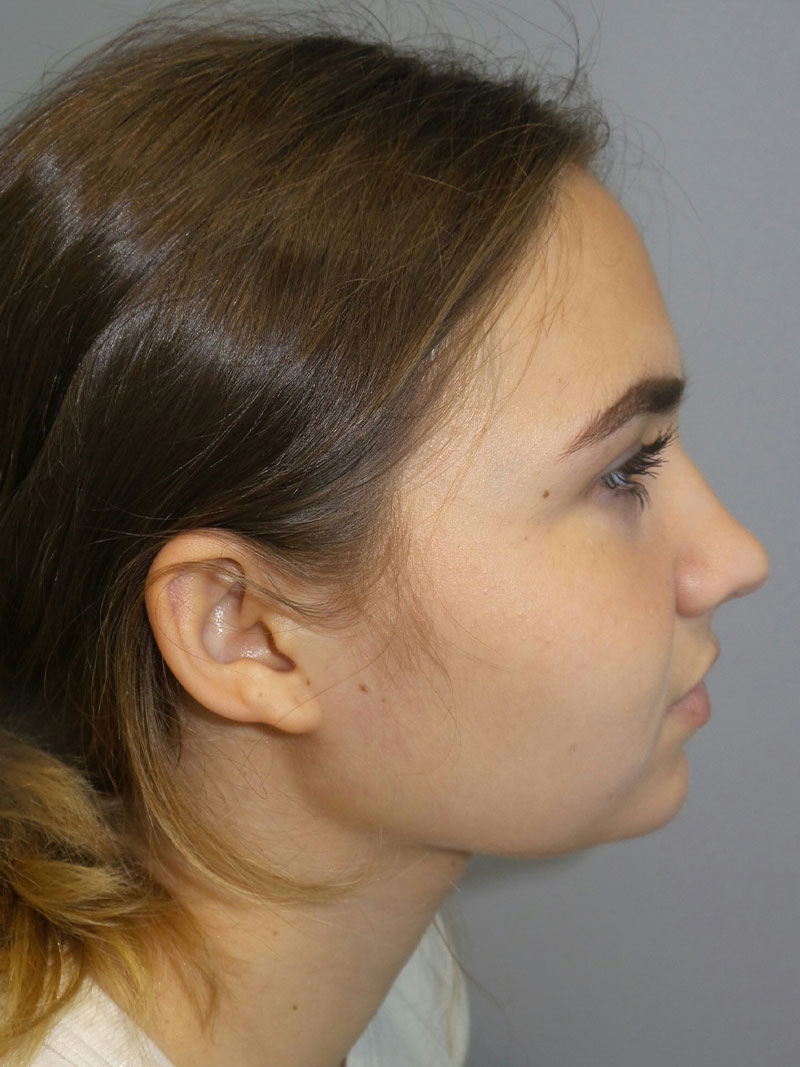 Buccal Fat Reduction Before and After 02 | Grover Aesthetics