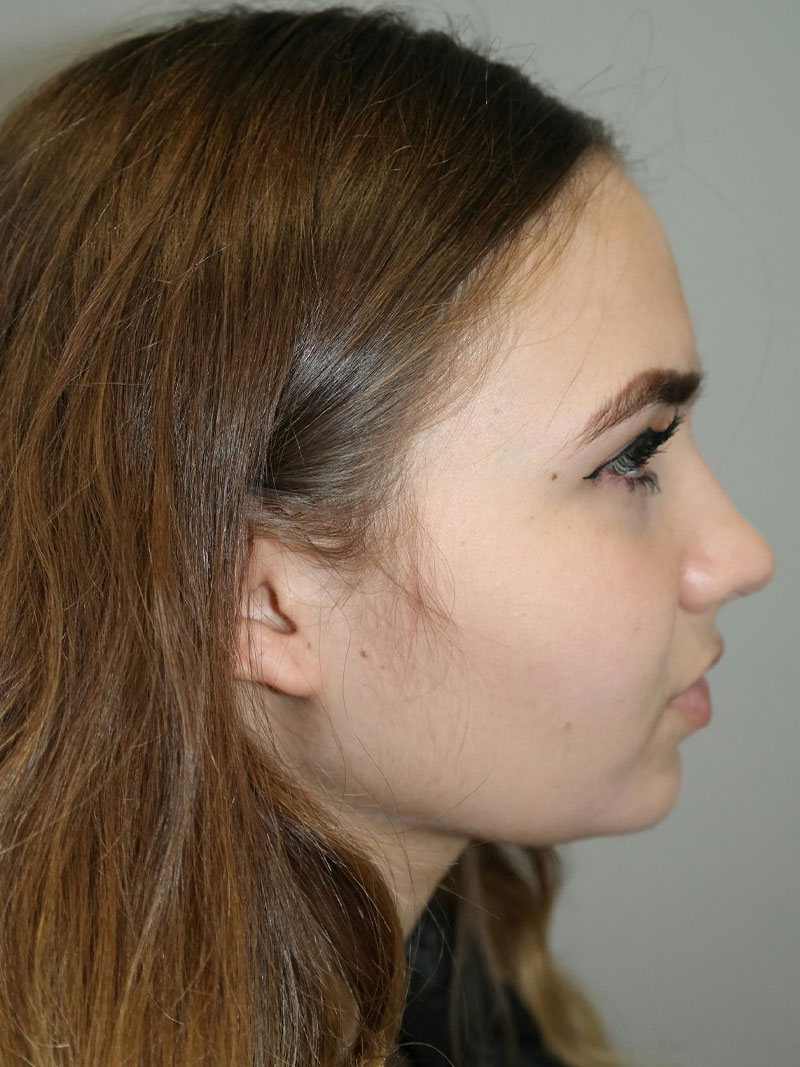 Buccal Fat Reduction Before and After 02 | Grover Aesthetics