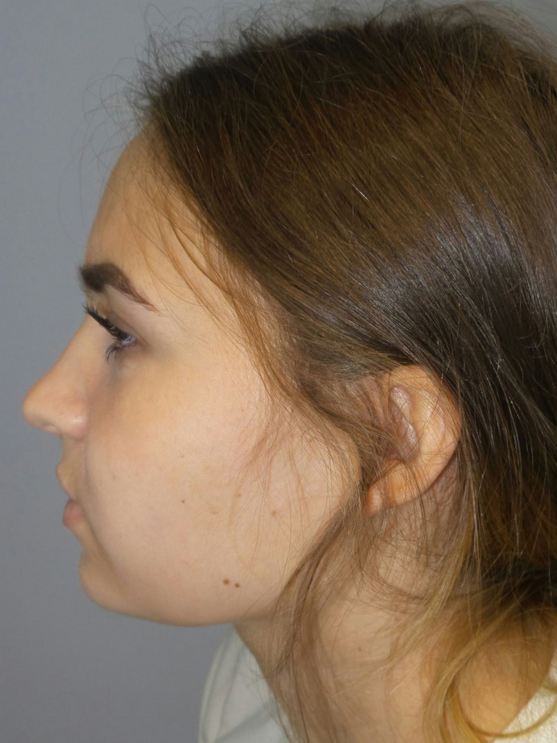 Buccal Fat Reduction Before and After 02 | Grover Aesthetics