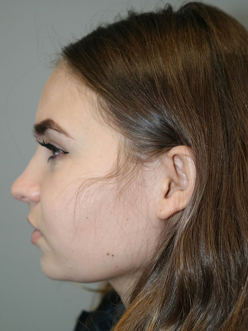 Buccal Fat Reduction Before and After 02 | Grover Aesthetics