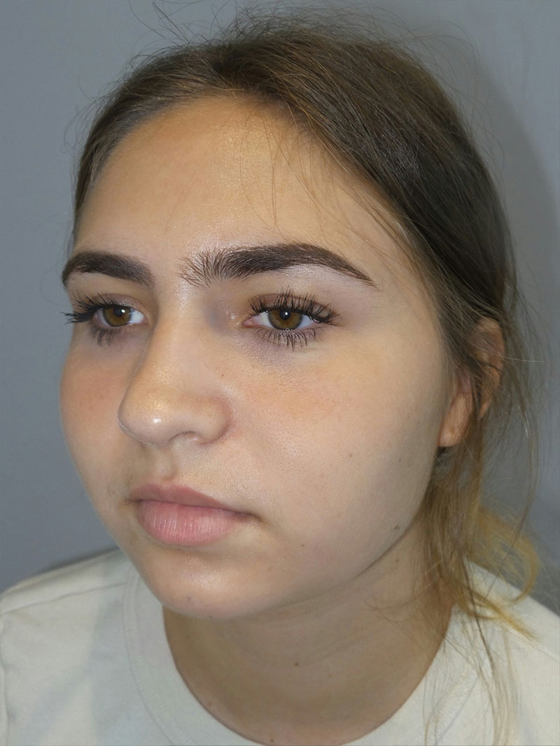 Buccal Fat Reduction Before and After 02 | Grover Aesthetics