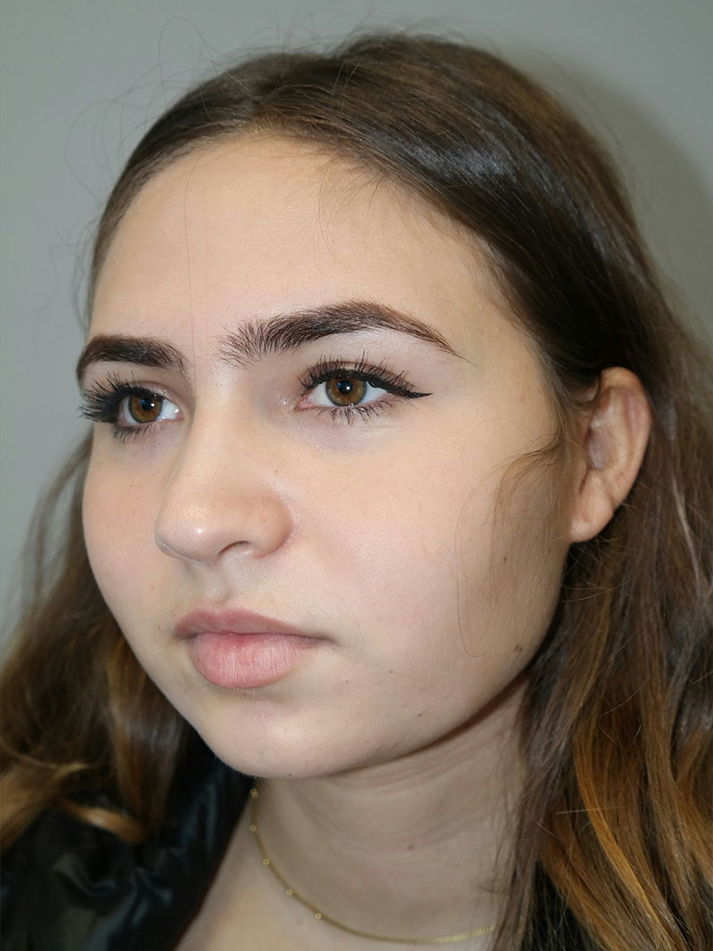 Buccal Fat Reduction Before and After 02 | Grover Aesthetics