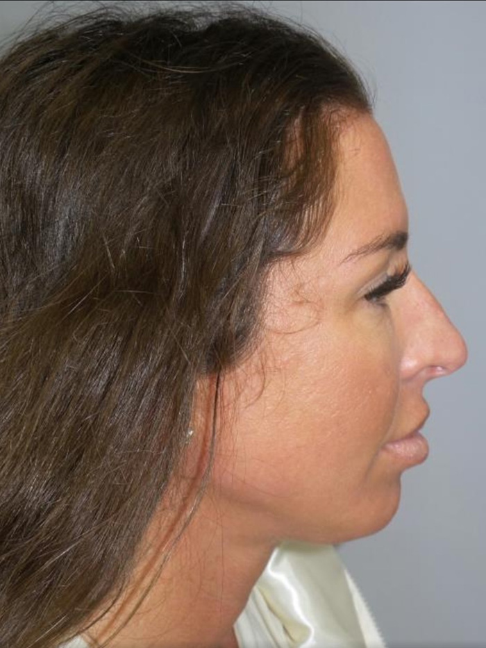 Chin Augmentation Before and After | Grover Aesthetics