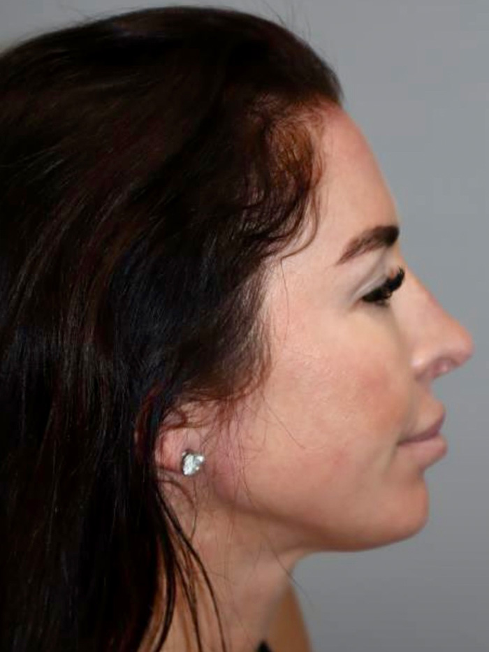 Chin Augmentation Before and After 01 | Sanjay Grover MD FACS