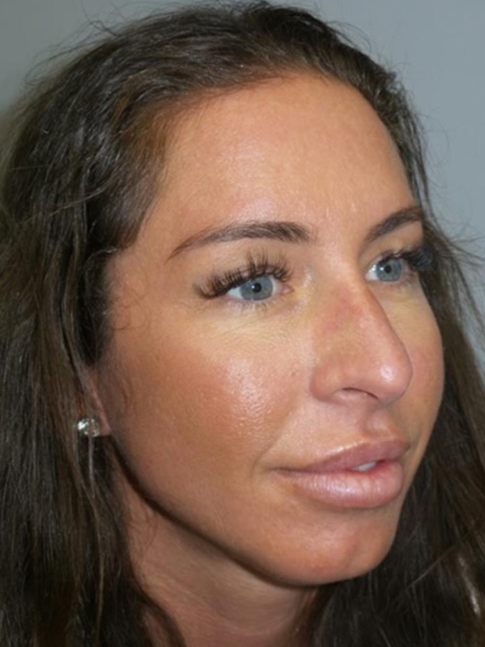 Chin Augmentation Before and After 01 | Grover Aesthetics