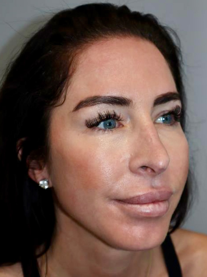Chin Augmentation Before and After 01 | Grover Aesthetics
