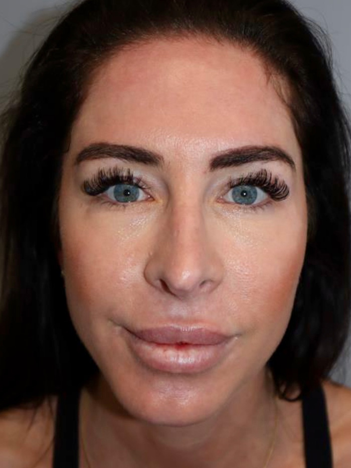 Chin Augmentation Before and After 01 | Grover Aesthetics