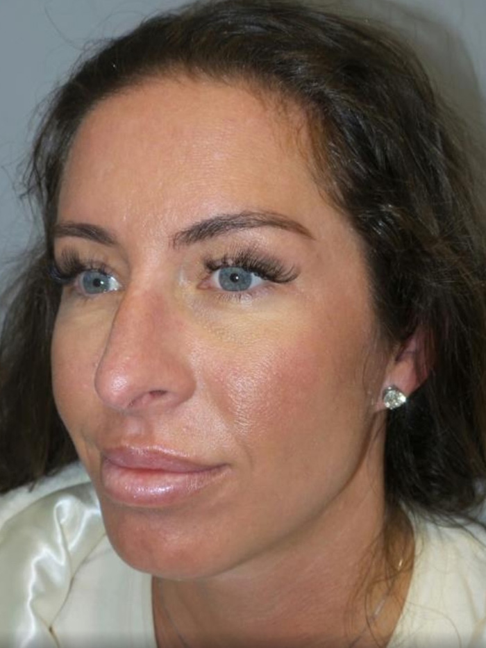 Chin Augmentation Before and After 01 | Grover Aesthetics