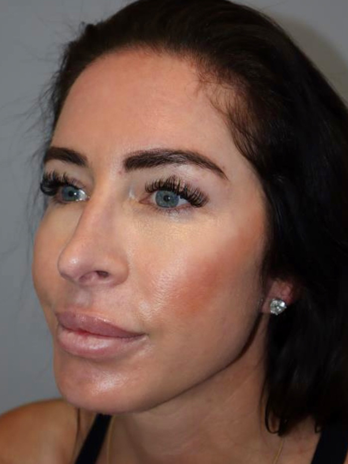 Chin Augmentation Before and After 01 | Grover Aesthetics