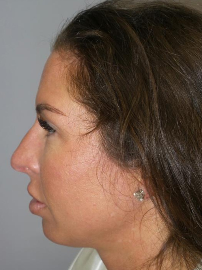 Chin Augmentation Before and After 01 | Grover Aesthetics