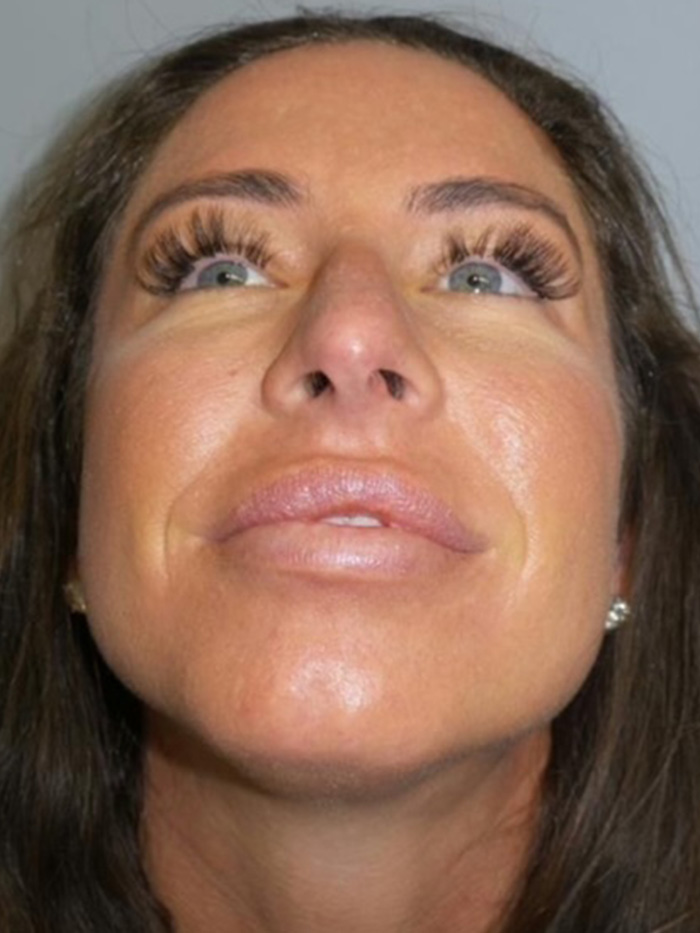 Chin Augmentation Before and After 01 | Grover Aesthetics