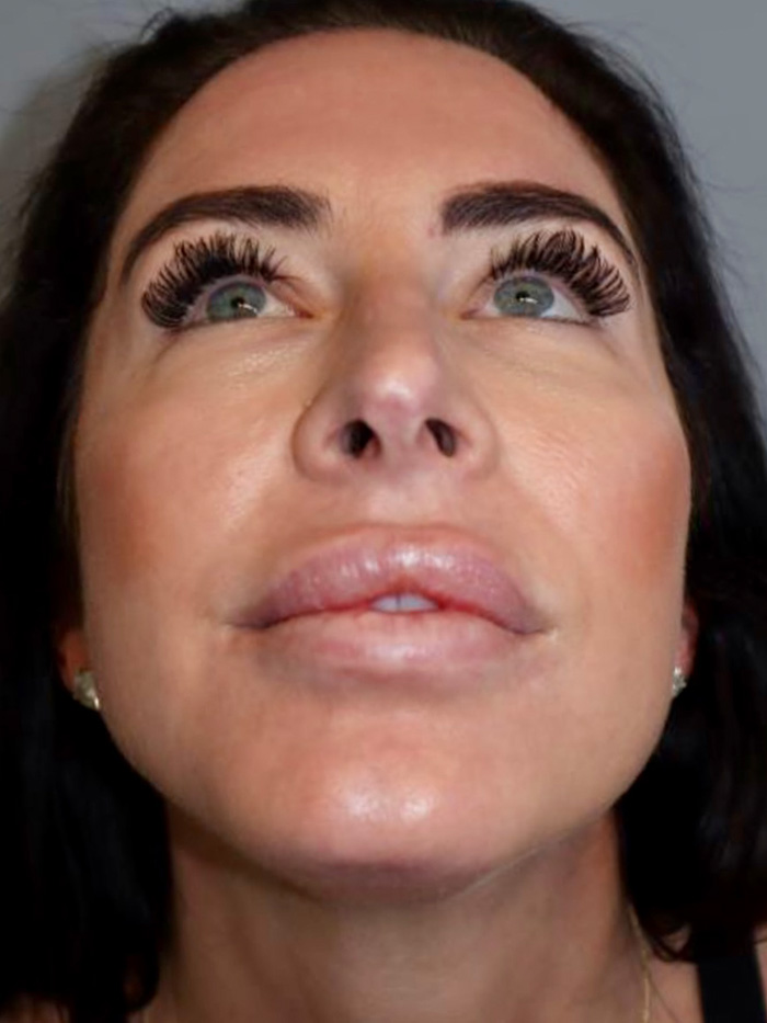 Chin Augmentation Before and After 01 | Grover Aesthetics