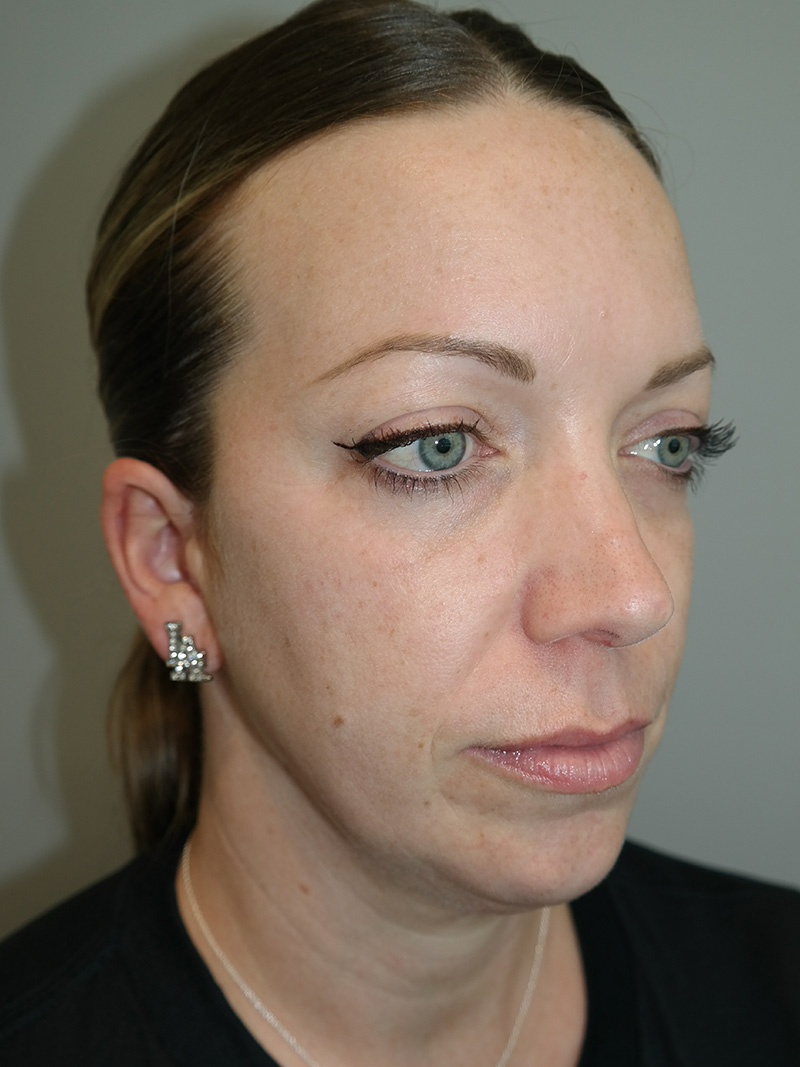 Chin Augmentation Before and After | Grover Aesthetics