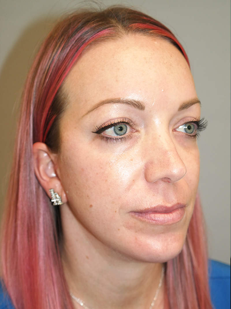 Chin Augmentation Before and After | Grover Aesthetics