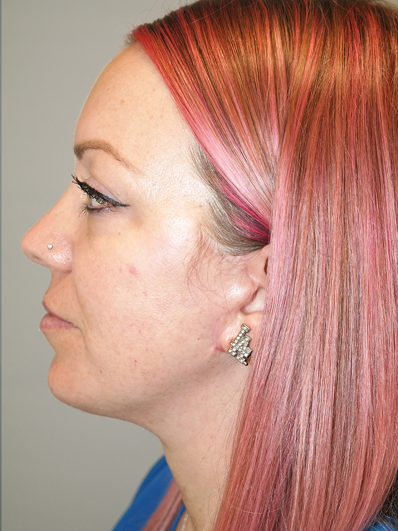 Chin Augmentation Before and After 02 | Sanjay Grover MD FACS