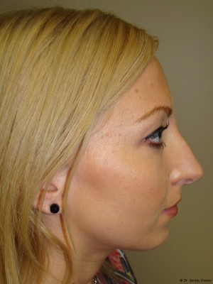 Chin Augmentation Before and After | Grover Aesthetics
