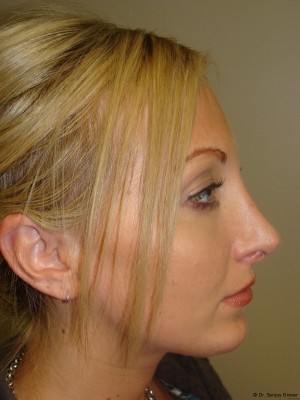 Chin Augmentation Before and After | Grover Aesthetics