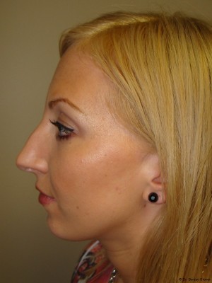 Chin Augmentation Before and After 03 | Grover Aesthetics