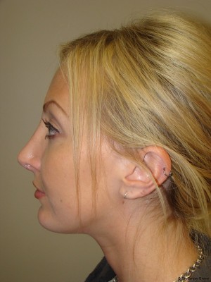 Chin Augmentation Before and After 03 | Grover Aesthetics