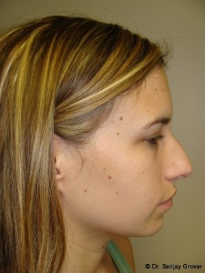 Chin Augmentation Before and After | Grover Aesthetics