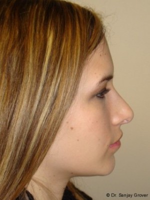 Chin Augmentation Before and After | Grover Aesthetics