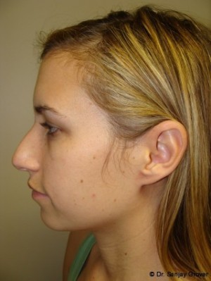 Chin Augmentation Before and After 04 | Sanjay Grover MD FACS