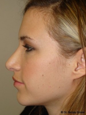 Chin Augmentation Before and After 04 | Sanjay Grover MD FACS