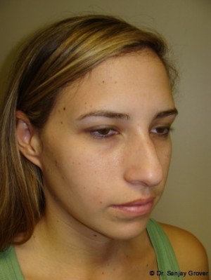Chin Augmentation Before and After 04 | Grover Aesthetics